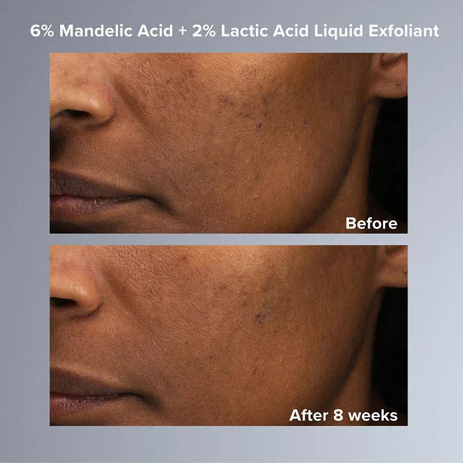 Multi-level exfoliation kit