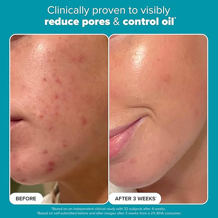 Skin perfecting 2% bha,Liquid salicylic acid exfoliant, gentle facial exfoliator for blackheads, large pores, wrinkles & fine lines, travel size, 1 fluid ounce - packaging may vary