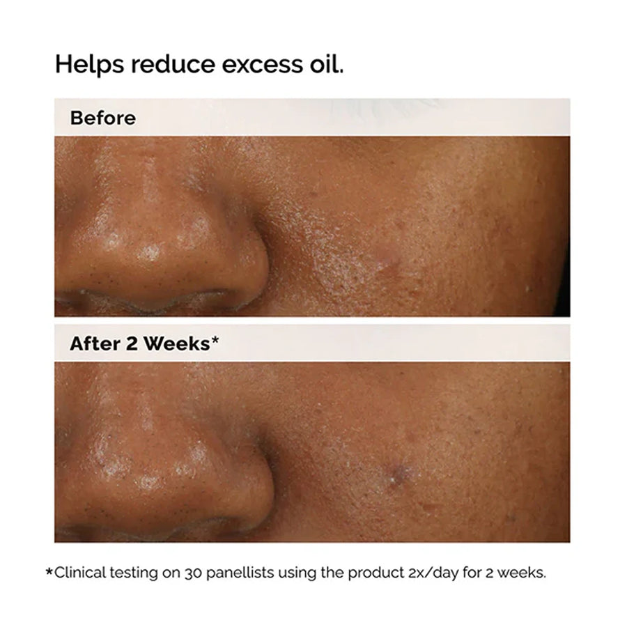 Balancing & clarifying serum for blemish-prone skin